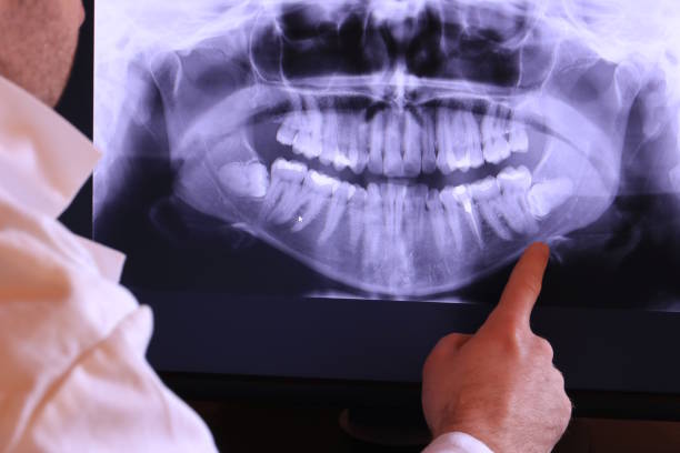 Best Emergency Wisdom Tooth Extraction in Scottville, MI