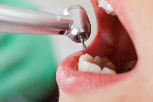 Best Knocked-Out Tooth (Avulsed Tooth) Treatment in Scottville, MI